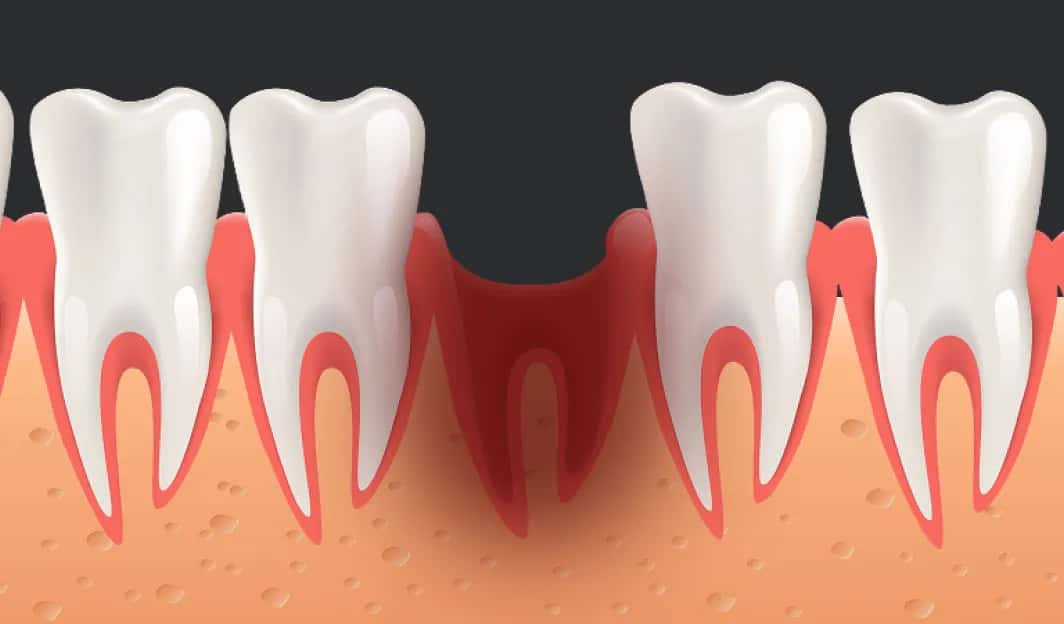 Ile goi się dziąsło? Czas gojenia, porady i jak uniknąć suchego zębodołu